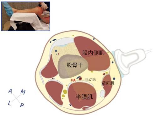 图9显示髌骨上方大腿的横断面的解剖结构图10超声引导下髌骨上方大腿