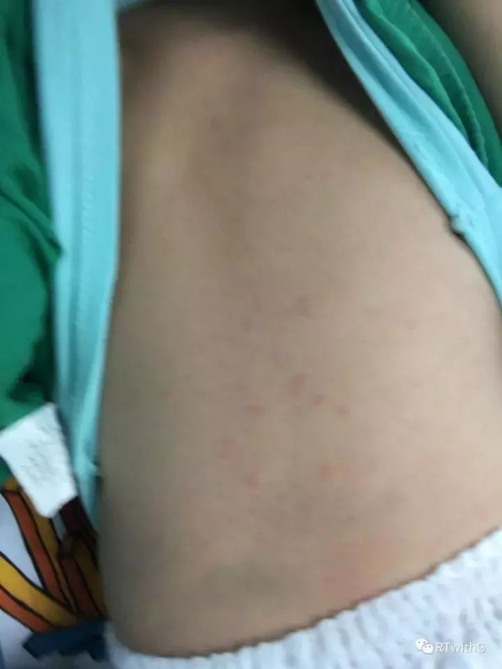 川崎病的皮疹图片
