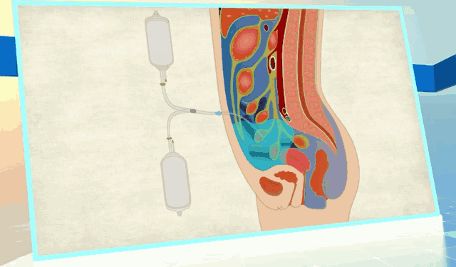 腹透居家手册丨第七章腹膜换液步骤
