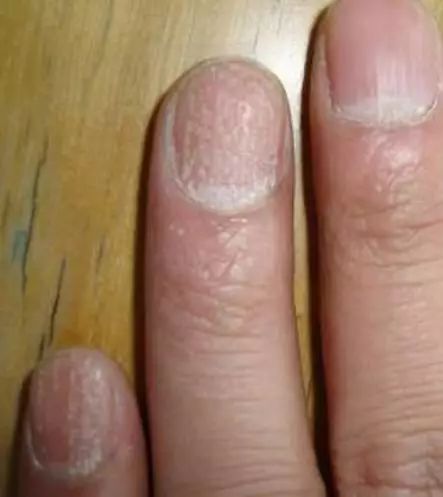 指甲上有黑线竟是癌症前兆出现这8种指甲情况你一定要注意