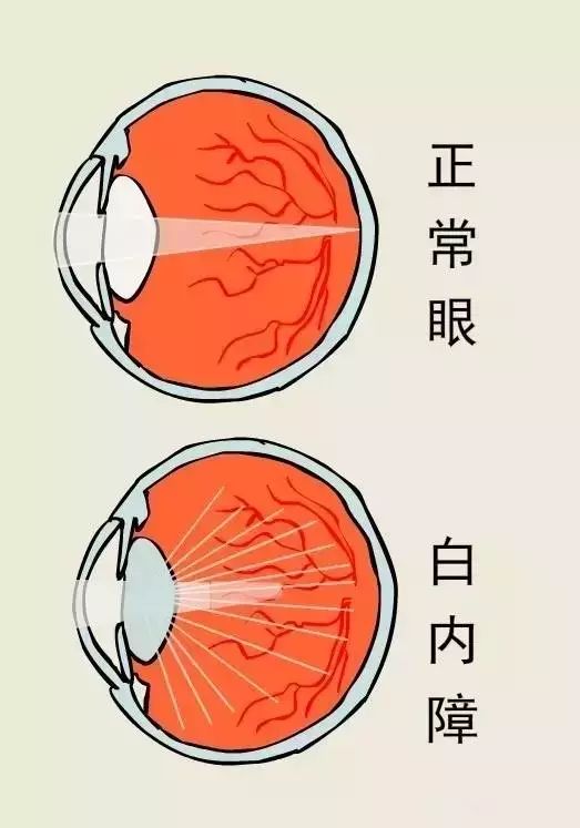 科普一則漫畫告訴你白內障真相