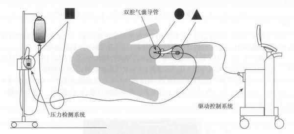 图2双腔气囊导管:主动脉内气囊采用高分子材料聚氨酯制成(图3),囊壁薄