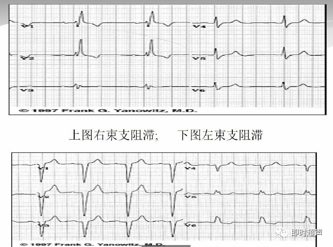 常見心電圖及心肌梗死心電圖的診斷