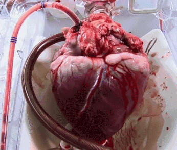 世界上第一颗人造心脏图片