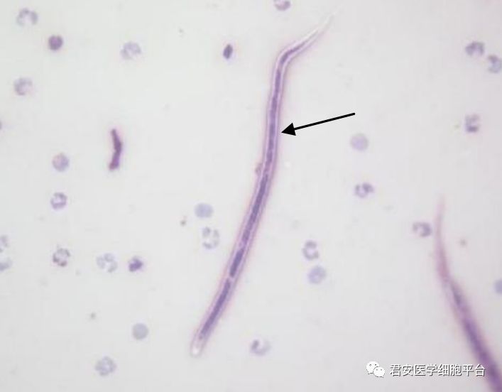 马来微丝蚴镜下图片