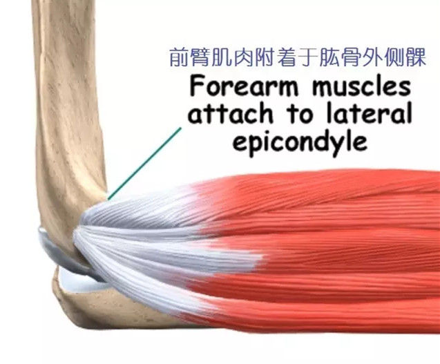 網球肘最初會在肘關節外側的隆起(即外上髁)處發生疼痛.