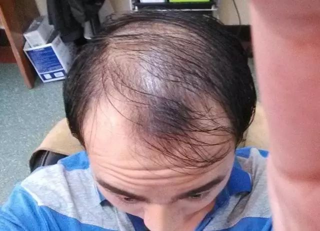 秃顶10年大叔逆袭小鲜肉脱发秃顶m型脱发这样做可永久解决