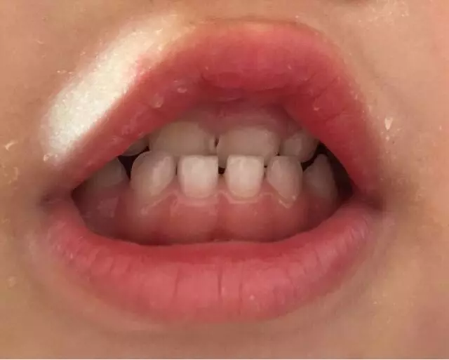 牙齿畸形 恐怖图片