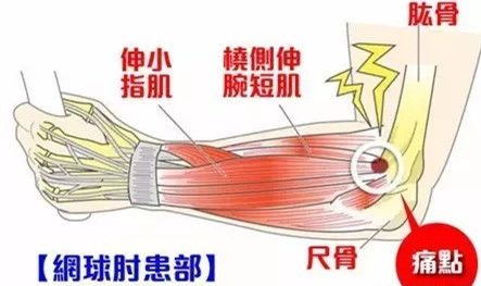 肱骨外上髁有侷限性壓痛點,或在肽橈關節處或環狀韌帶處.