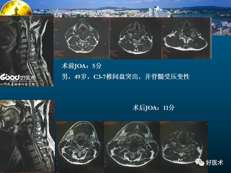 頸椎病的mri診斷技巧