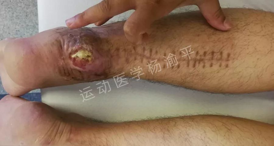 跟腱手術是一個比較有風險的手術且看跟腱術後傷口破潰並不是一個少見