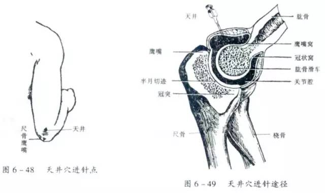 天井穴進針點操作方法:患者屈肘90度,在肘尖(尺骨鷹嘴)直上1寸凹陷處