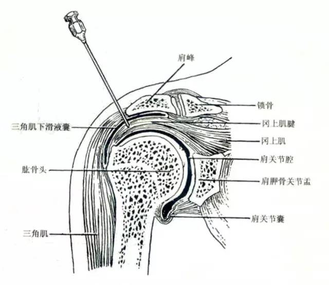 (三)后方进针法臑俞穴进针点操作方法:患者取端坐位,上臂内收,腋后纹