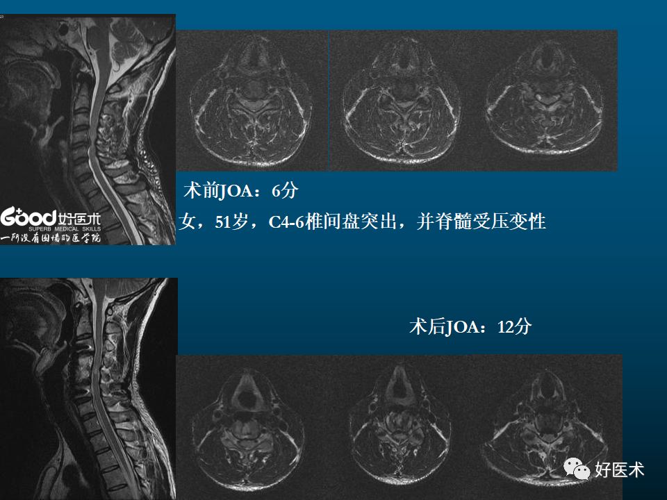 颈椎mri平扫图解图片