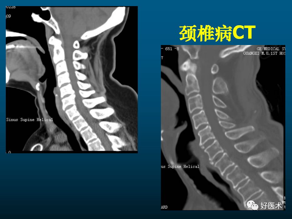 颈椎病mri图片讲解图片