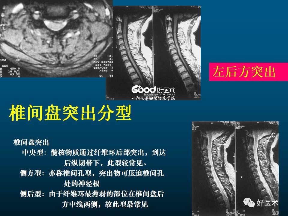 颈椎病的mri诊断技巧