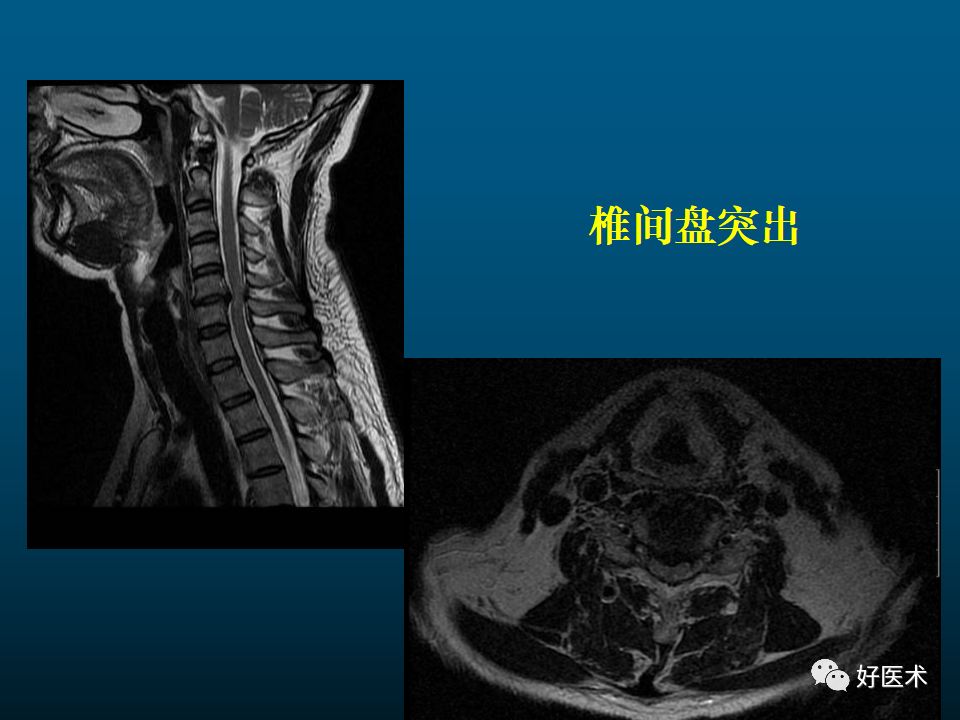 颈椎病mri图片讲解图片