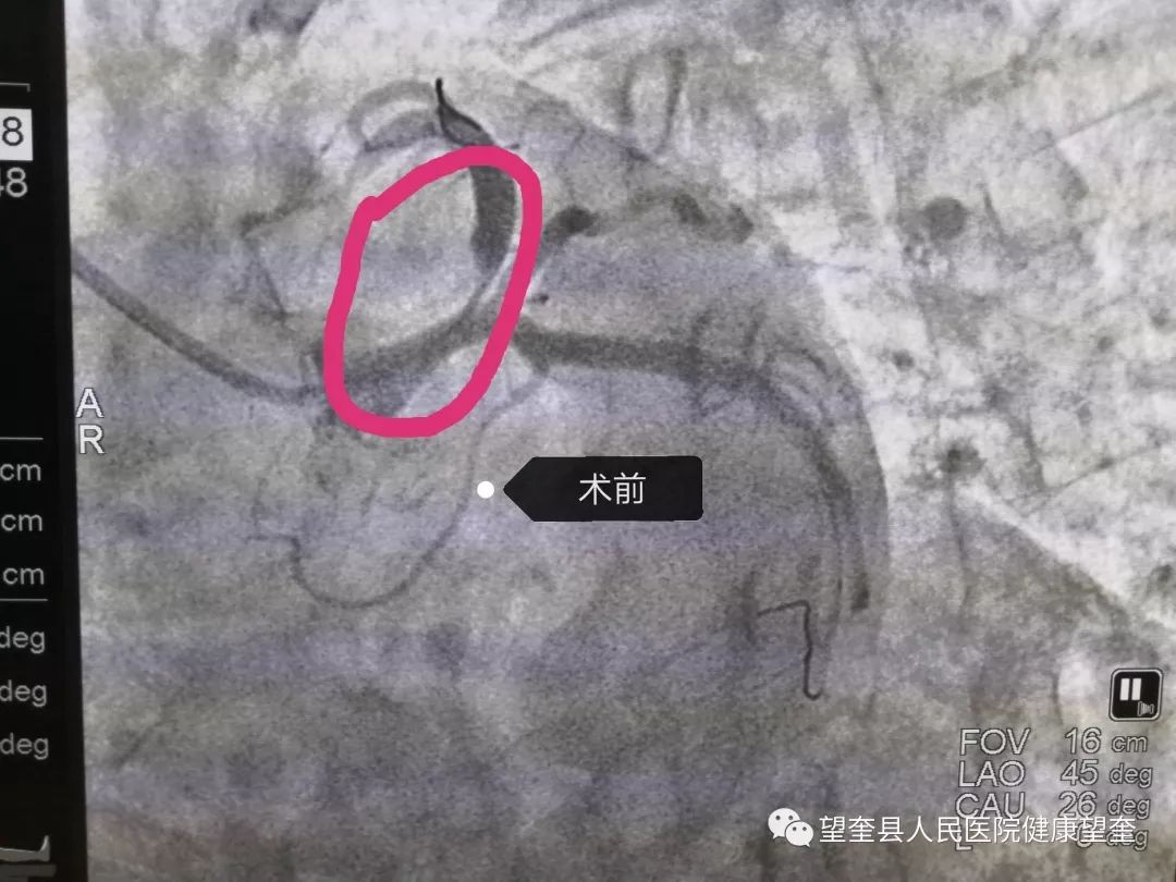 望奎縣人民醫院心內一科冠脈支架手術再上新臺階