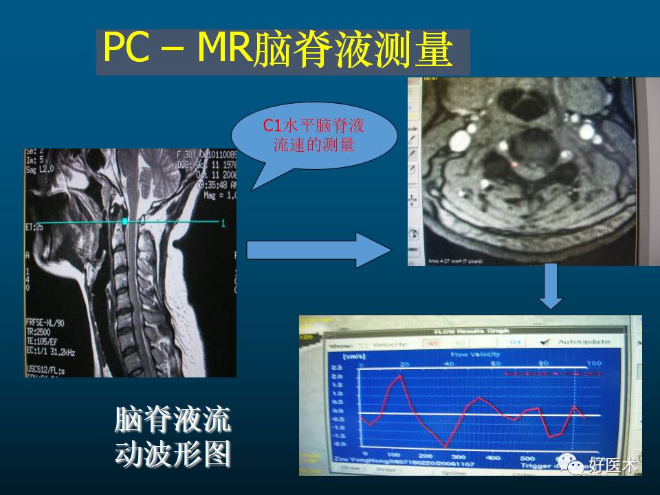 颈椎mri平扫图解图片