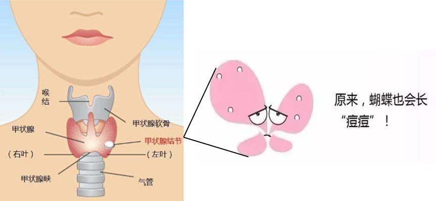 甲狀腺結節到底切不切這個檢測告訴你答案