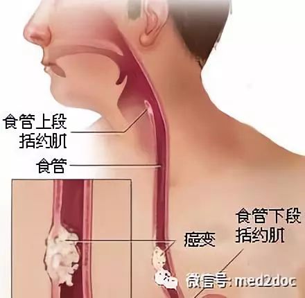 10大高發癌症的早期徵兆,高發人群,排查方法