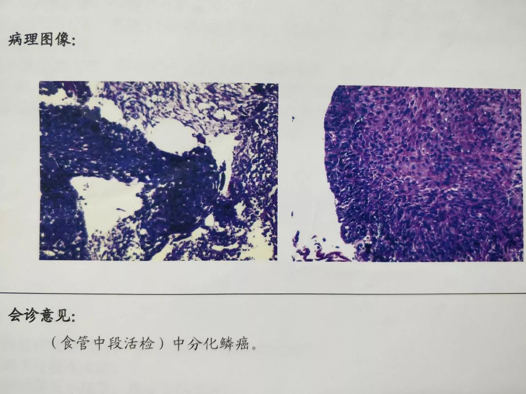 增強ct(圖二)等檢查,明確為食管中段佔位,病變較長,切片經病理科會診