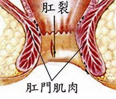 真男人无法言说的痛—肛裂