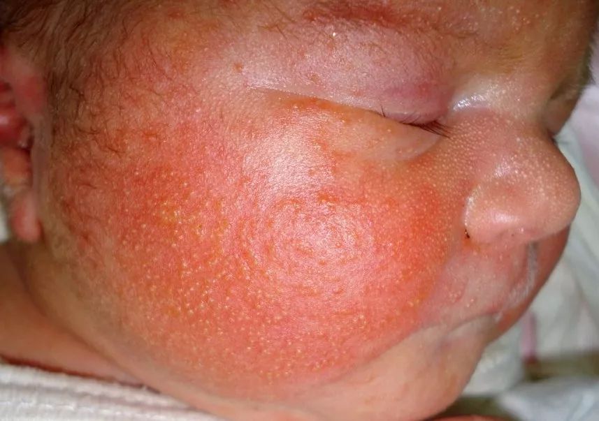 新生婴儿脸上有红斑图图片