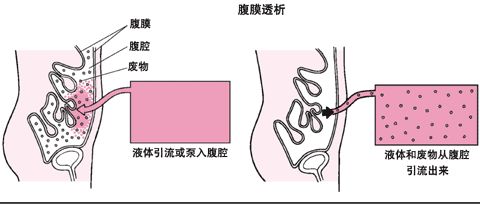 腹膜透析的原理图片