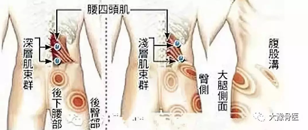 胸背肌筋膜炎的症状图图片