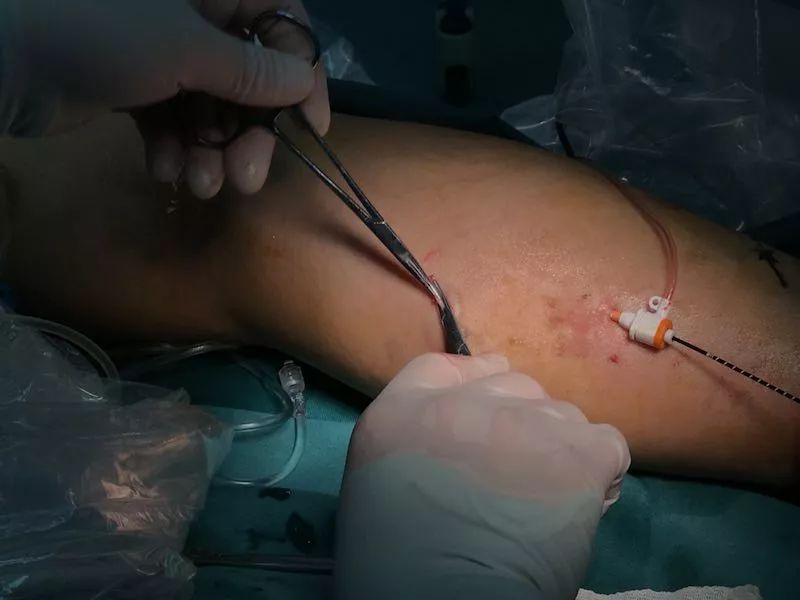 【空总要闻】空军总医院心脏中心采用最新微创技术治疗下肢静脉曲张
