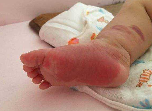 新生儿红斑图片