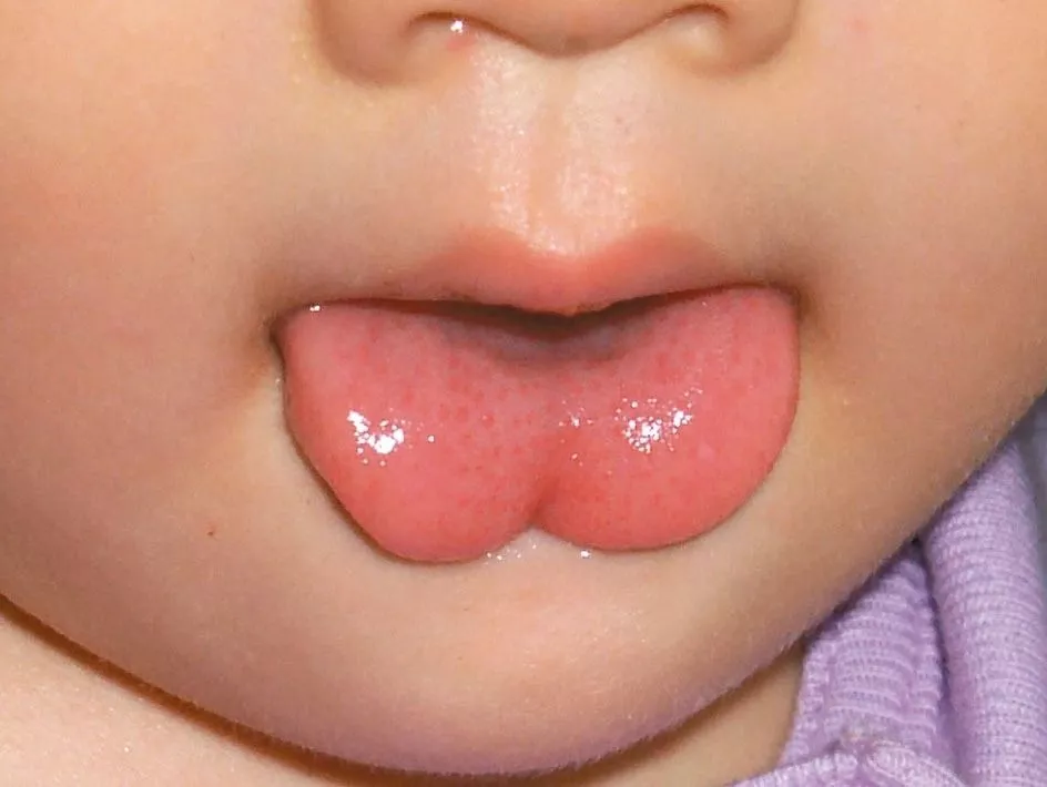 儿童舌头正常图片图片