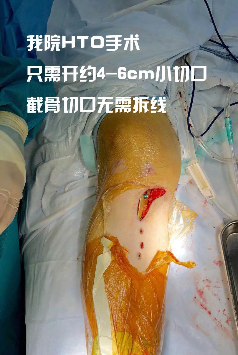 o型腿截骨手术图片图片
