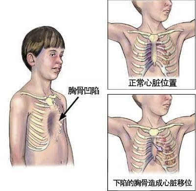 小孩剑突突出图片图片