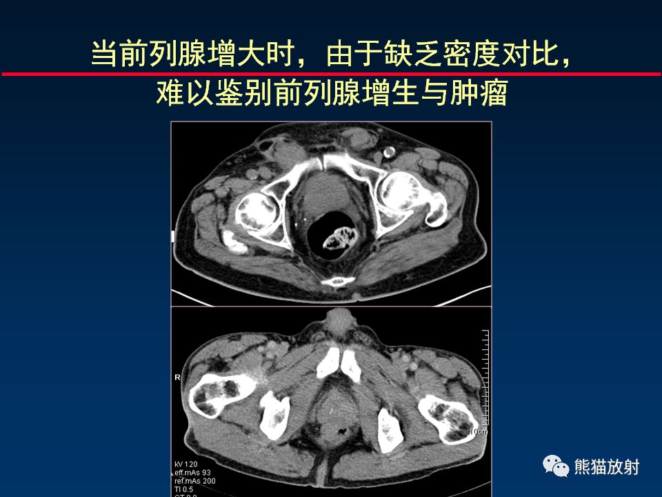 泌尿生殖系统疾病丨ct的价值和限度