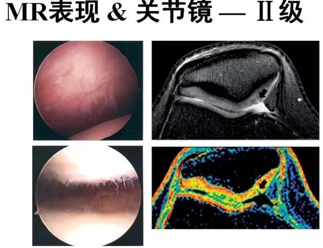 髌骨软化核磁共振图像图片