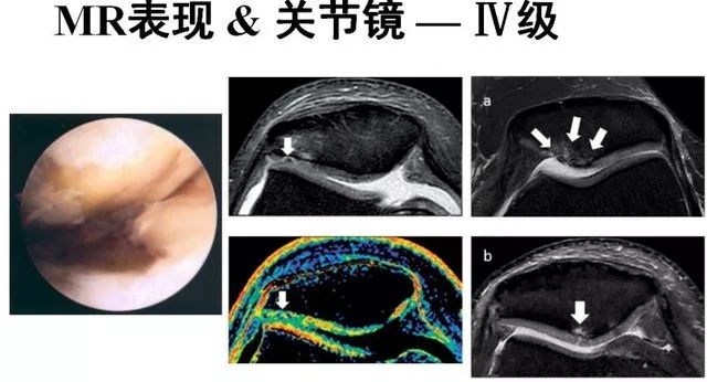 髌骨软化核磁共振图像图片