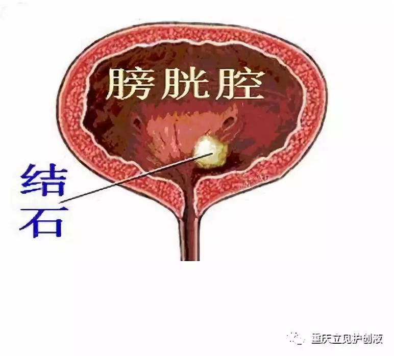 输尿管膀胱入口位置图图片