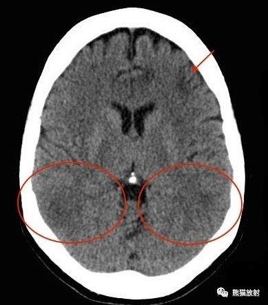基底节区低密度灶图片