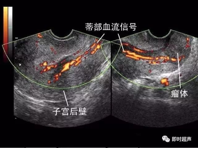 子宮肌瘤超聲分類診斷