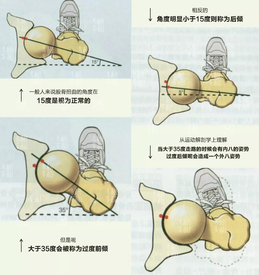 股骨颈前倾角测量图片图片