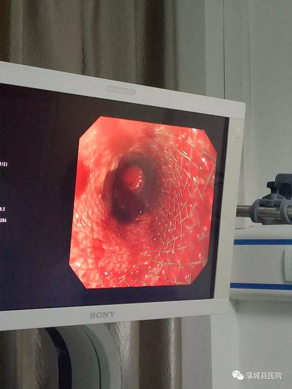 蒲城县医院消化肿瘤科自成立以来,内镜下治疗已逐步开展息肉切除术