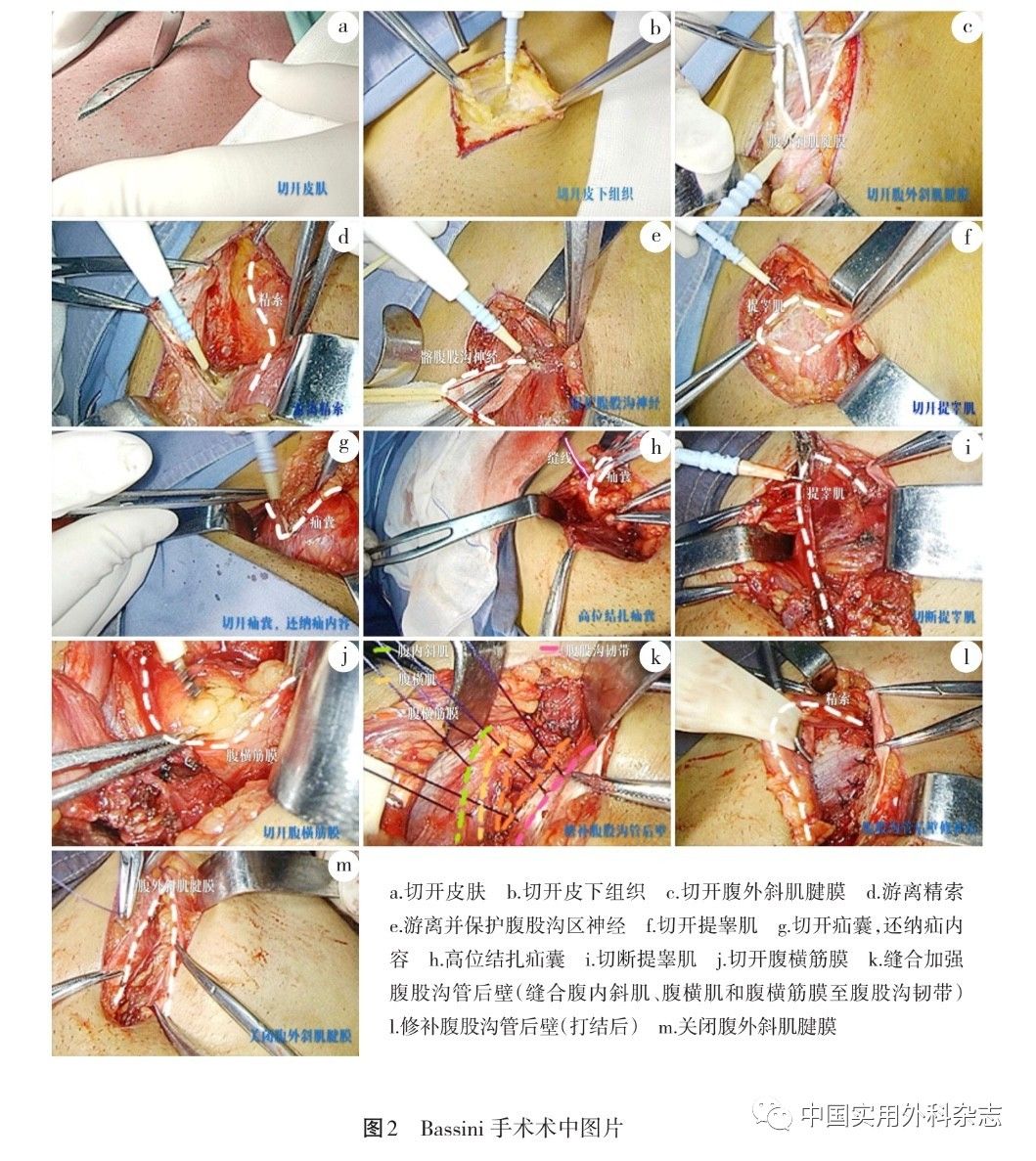 丁字带托起阴囊图片