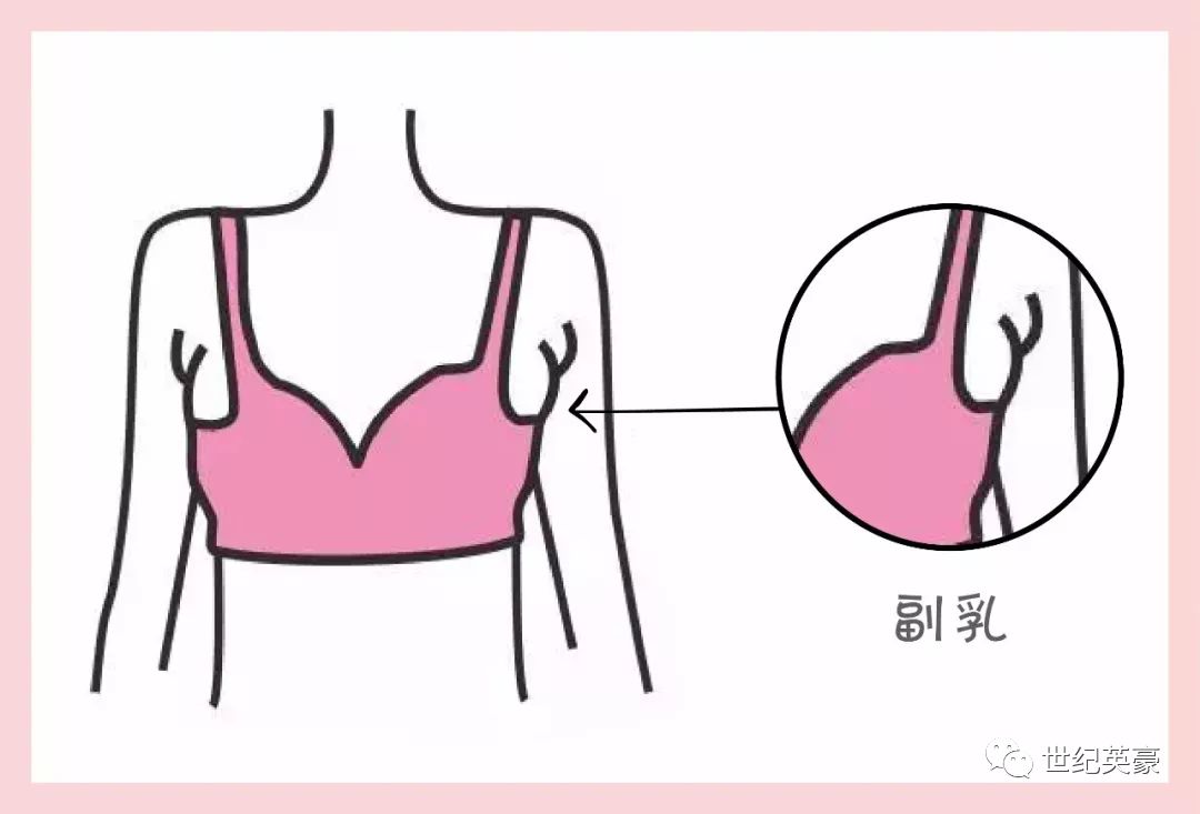 先天的副乳-因為病理性的副乳大多是一個單獨的乳房所以在治療的時候