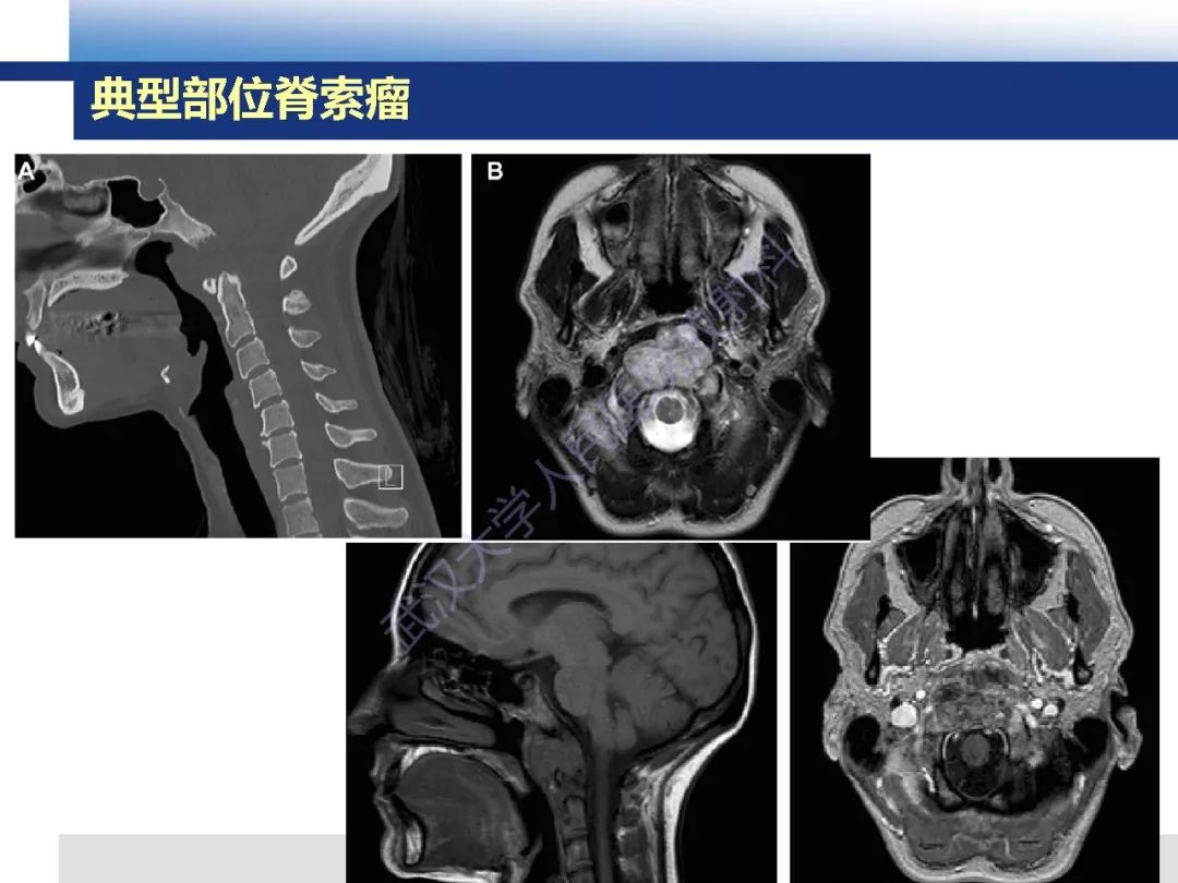 颅底软骨样脊索瘤影像诊断