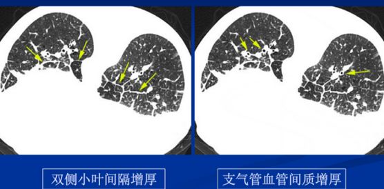 肺小叶间隔增厚图片