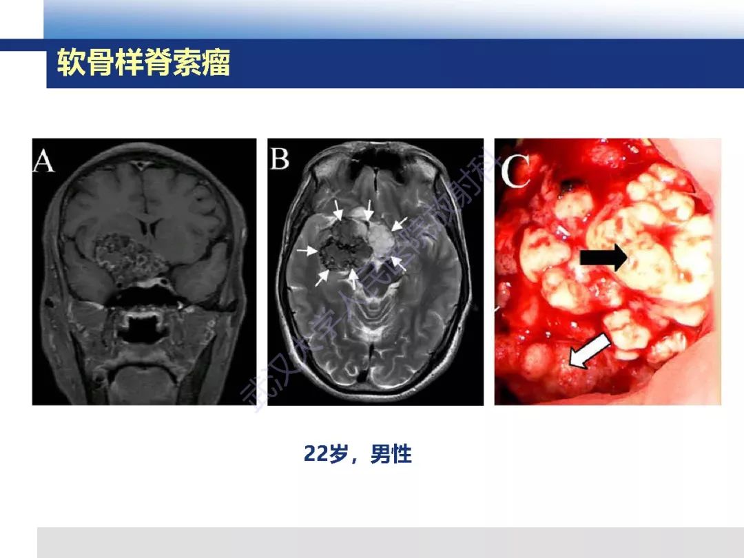 颅底软骨样脊索瘤影像诊断