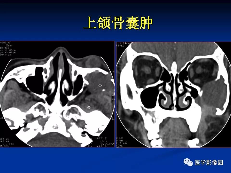 鼻腔鼻竇良惡性腫瘤的ctmr診斷一影像天地