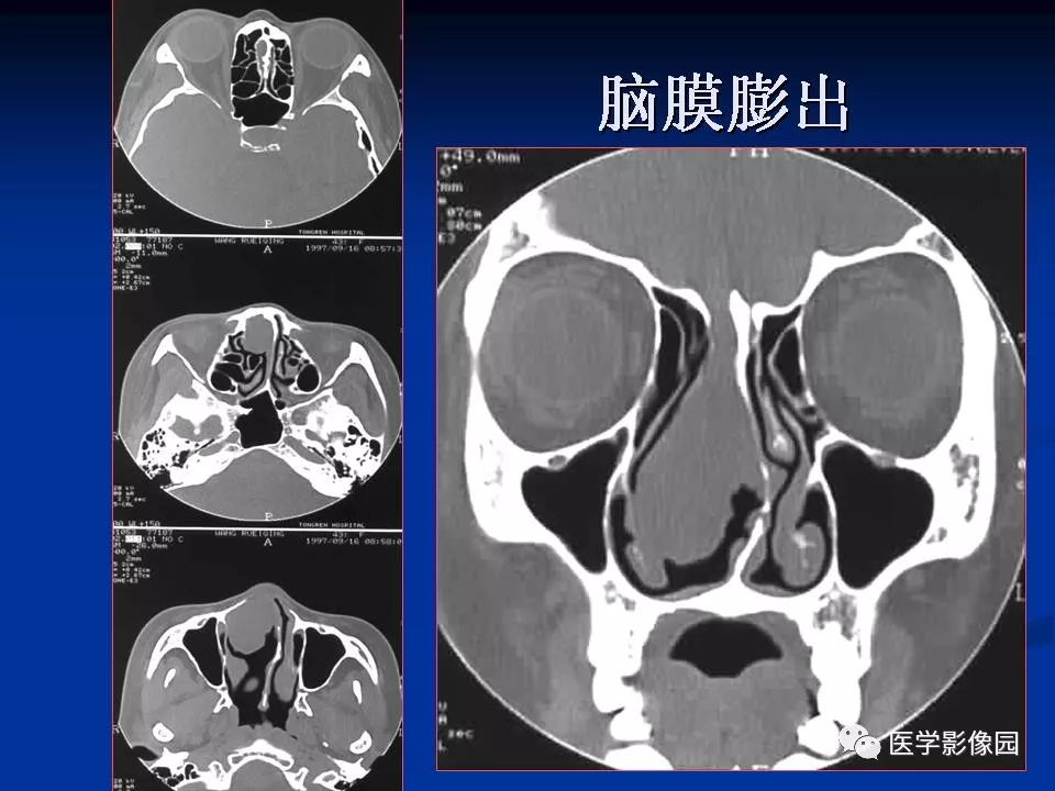 鼻腔鼻竇良惡性腫瘤的ctmr診斷一影像天地